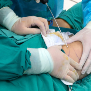 Advanced Liposculpting Course