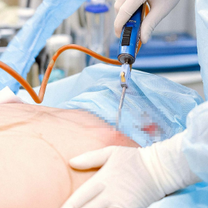 Advanced Liposculpting Course with Fat Transfer